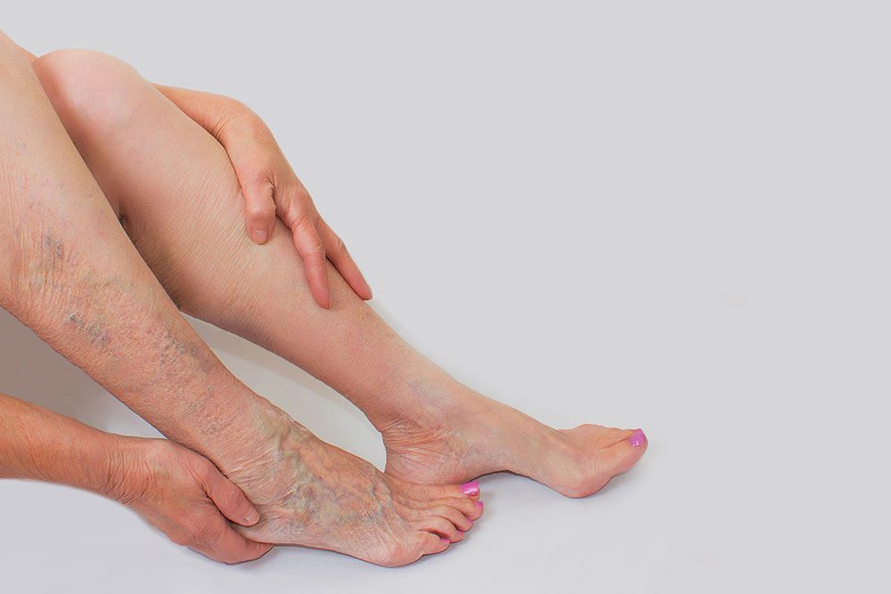 Hautarzt Neuss Leistungen 1 Hautarzt Neuss hautaerztin neuss dr lilian vourvouli rickers leistungen venenheilkunde